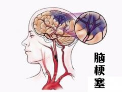 養(yǎng)成好的生活習(xí)慣，能夠有效預(yù)防腦梗塞